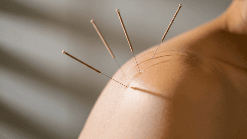 Akupunktur med nålar i axeln